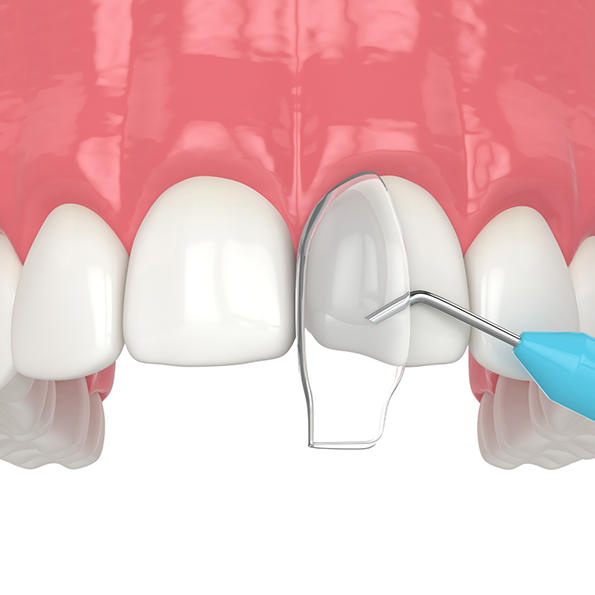 Illustration of bonding material being applied to a chipped front tooth