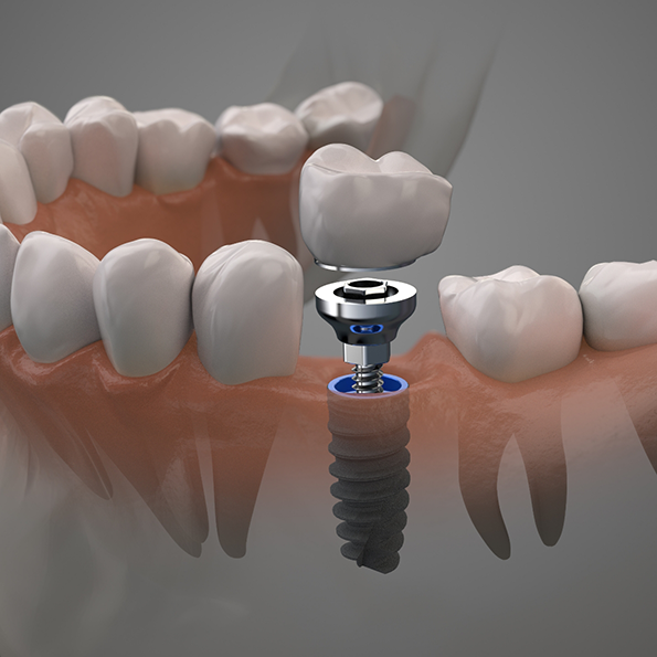 Illustration of a dental implant and crown replacing a missing lower tooth