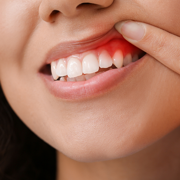 Close up of a person with red gums