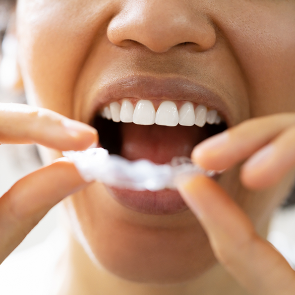 Close up of a person placing a nightguard over their teeth