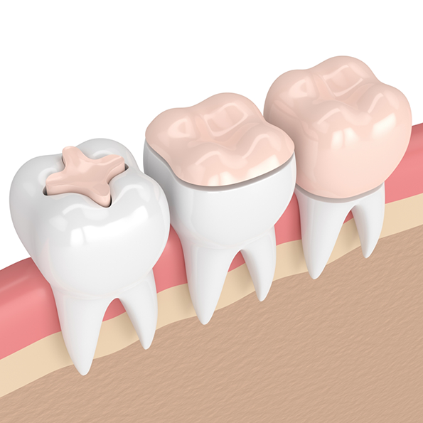 Illustration of two teeth with fillings next to a tooth with a dental crown