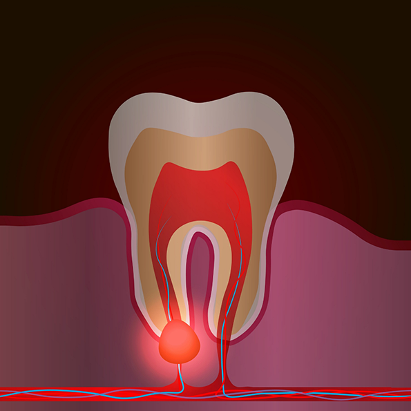 Illustration of a tooth with an infection near the root