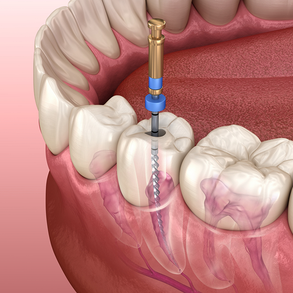 Illustration of a thin dental instrument treating the inside of a tooth